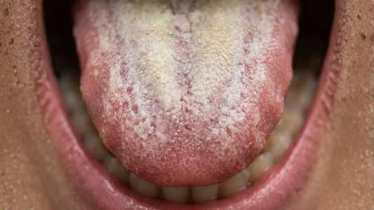 The White Coating on Your Tongue Is Linked to Alzheimer's Disease